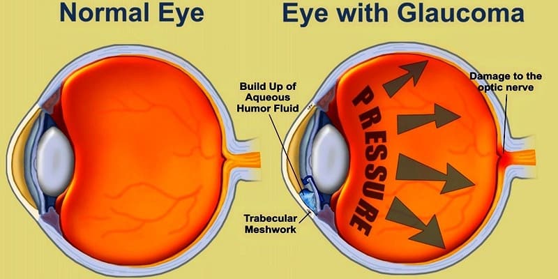 Радужные круги при глаукоме. Триада симптомов глаукомы. Фильтрационная подушка при глаукоме. Глаукома латынь