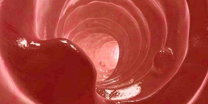 Apa Itu Kanker Usus Besar? • Deherba.com