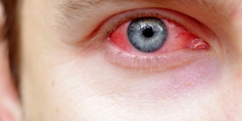  Mata  Merah Gejala Penyebab dan Tips Pengobatan Alami 