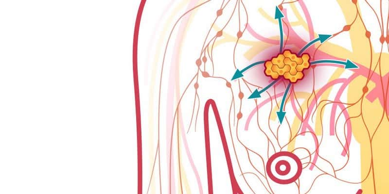 Kanker Payudara Stadium Tiga Info Krusial Bagi Para