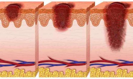 6 Ciri-Ciri Kanker Kulit yang Paling Mudah Dikenali
