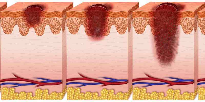 Stadium Kanker Kulit: Info Penting bagi Para Penderita Kanker