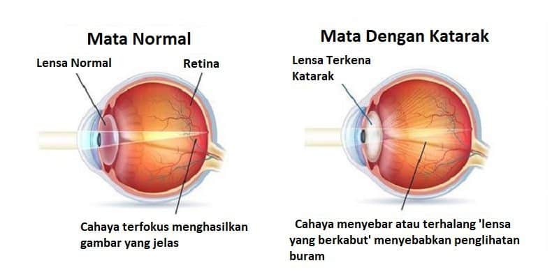 Katarak Info Seputar Penyakit Mata Deherba Com