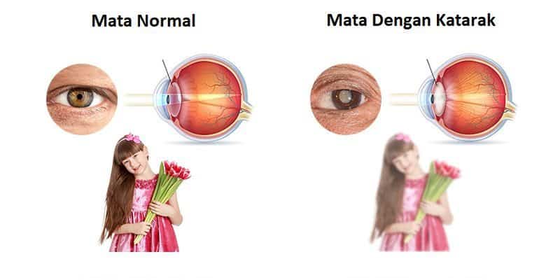 Ilustrasi: Perbedaan Mata Normal dengan Katarak