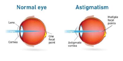 Penyakit Mata Silinder: Astigmatisma • Deherba.com