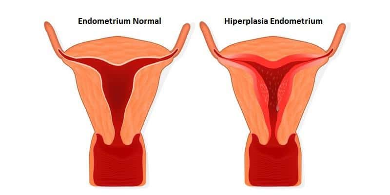 Ilustrasi Hiperplasia Endometrium