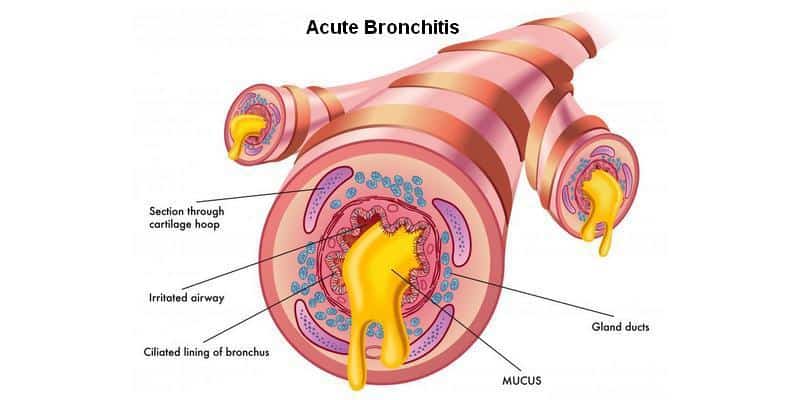penyakit bronkitis - bronkitis kronis - bronkitis akut - bronkitis pada anak - batuk bronkitis