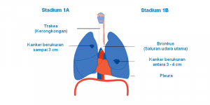 Kanker Paru-Paru: Info Lengkap bagi Anda yang Peduli Keshatan