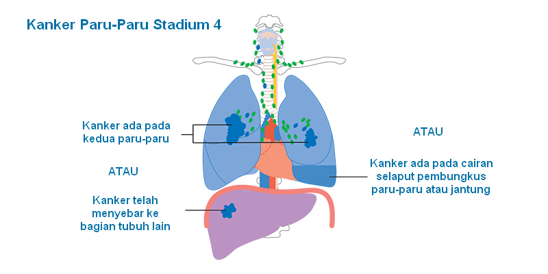 Kanker Paru-Paru Stadium 4: Info Penting bagi Para Penderita Kanker