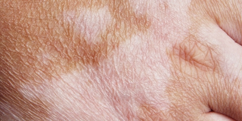 penyakit vitiligo - penyebab vitiligo - gejala vitiligo - bercak putih pada kulit - pengobatan vitiligo