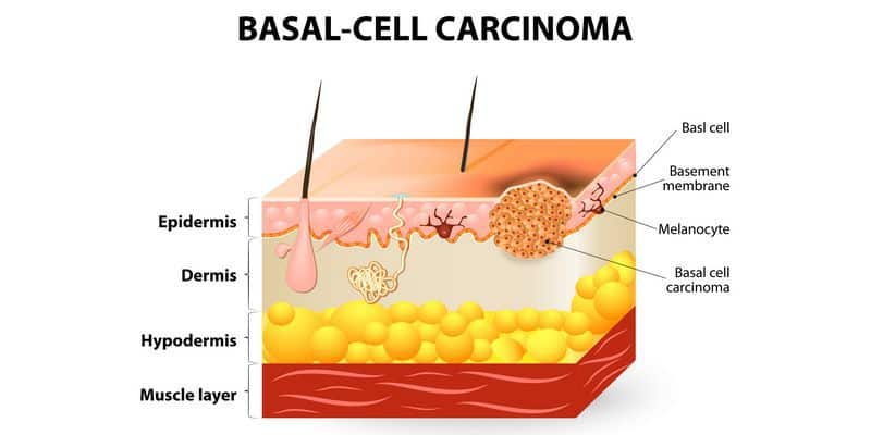 kanker karsinoma - karsinoma sel basal - karsinoma sel skuamosa - adenokarsinoma