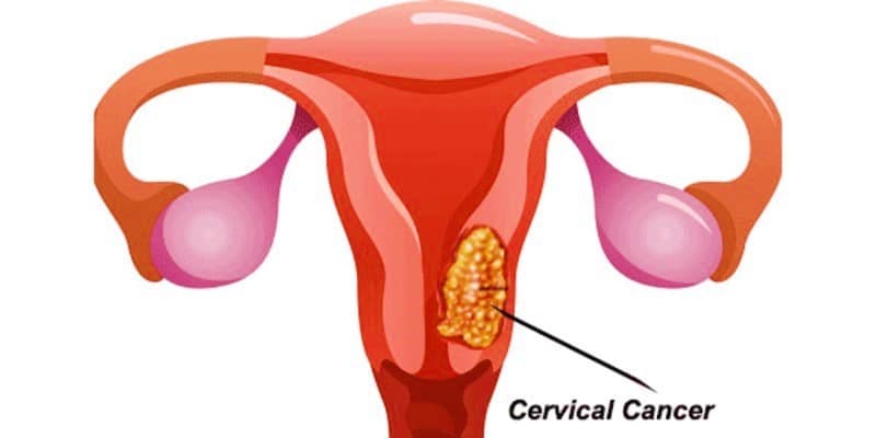 Penyakit Kanker Serviks Pada Wanita