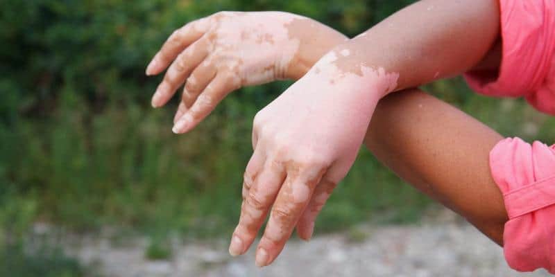 Vitiligo: Ketika Kulit Memiliki Bercak Putih • Deherba.com