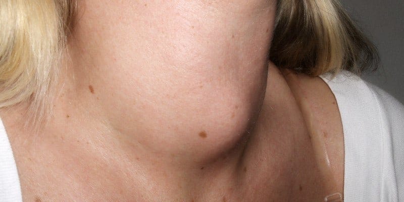 Ilustrasi benjolan di leher gejala tumor tiroid