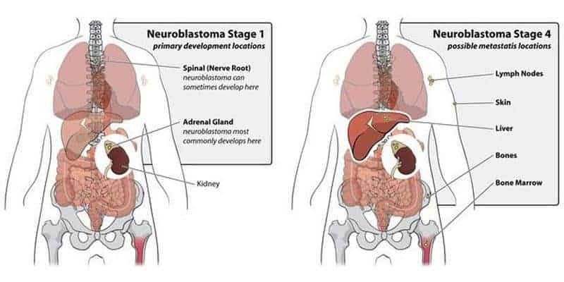 kanker neuroblastoma, neuroblastoma pada anak, gejala neuroblastoma, penyebab neuroblastoma, pengobatan neuroblastoma
