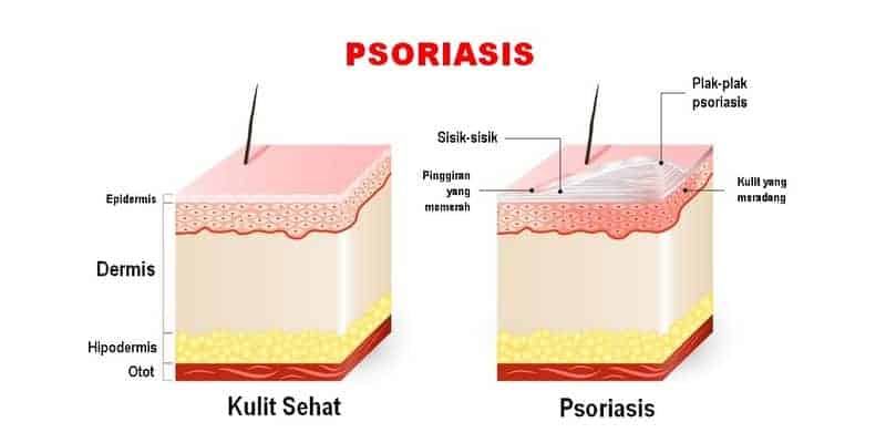 Ilustrasi penyebab psoriasis