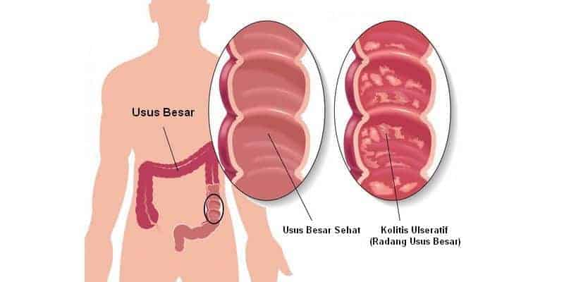 penyakit radang usus - radang usus besar - gejala radang usus - penyebab radang usus - cara mengobati radang usus