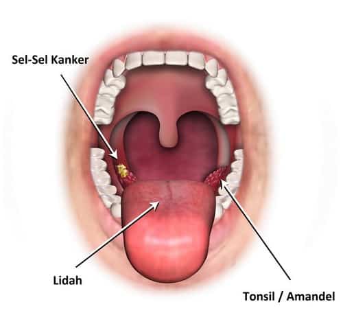 sel kanker di tonsil/amandel