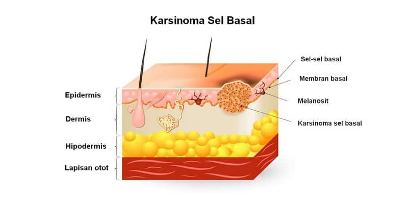 karsinoma sel basal