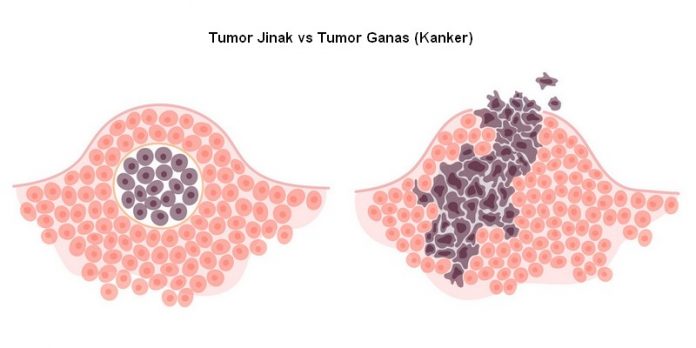 Tumor jinak vs tumor ganas