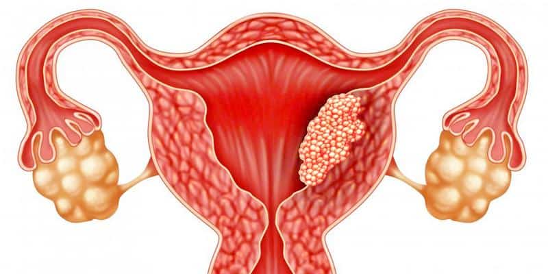 Kanker Rahim Dapat Menyebabkan Menstruasi Tidak Teratur