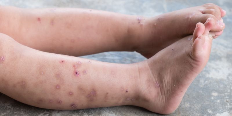 Jenis Penyakit Dermatitis Atopik pada Kaki Bayi