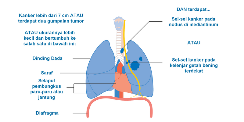 Kanker Paru-Paru Stadium 3: Info Penting bagi Para Penderita Kanker