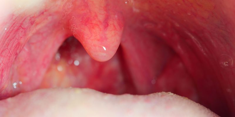 Ilustrasi gejala tonsilitis, amandel bengkak & merah