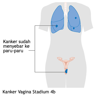 Kanker Vagina Stadium 4b