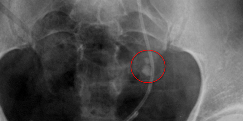 Gambar Batu Ginjal, Menggunakan X-Ray