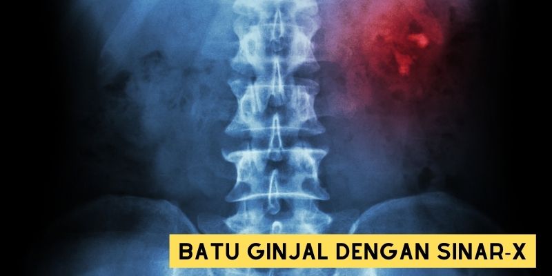 Gambar Bentuk Batu Ginjal dengan Sinar-X