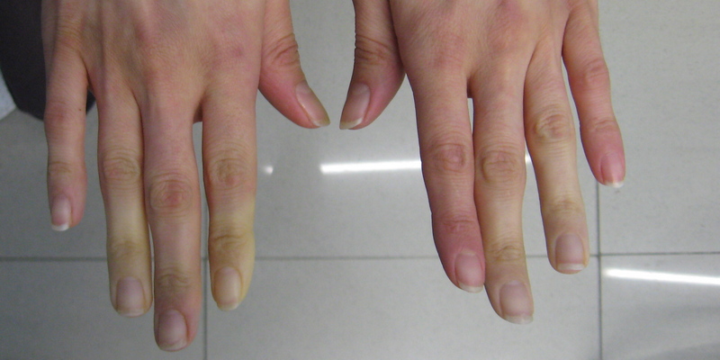 Sindrom Raynaud Penyebab Tangan Terasa Dingin