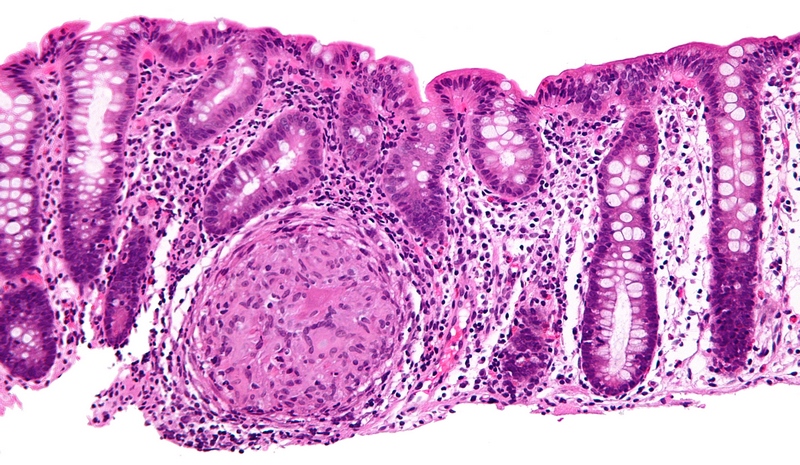 Gambar Penyakit Crohn
