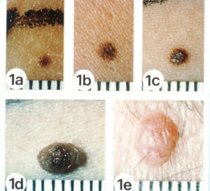 Kenali Perbedaan Tahi Lalat dan Kanker Kulit dengan Aturan ABCDE